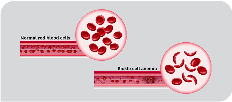 diagram: example of normal red blood cells and sickle cell anemia